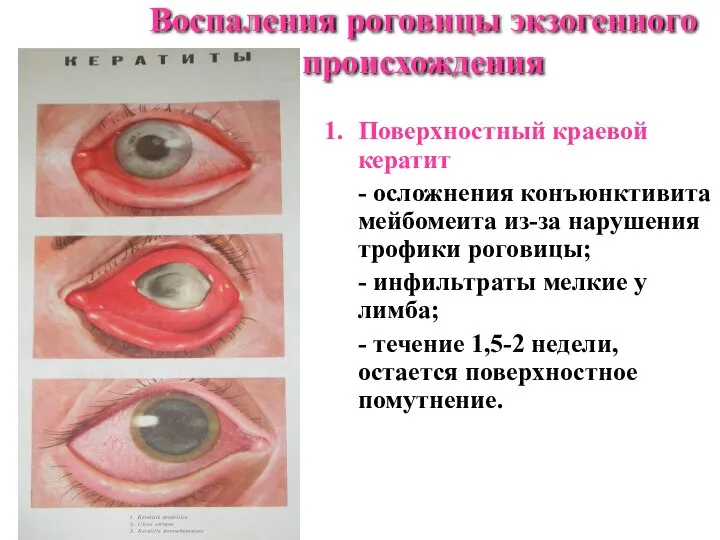 Воспаления роговицы экзогенного происхождения Поверхностный краевой кератит - осложнения конъюнктивита мейбомеита