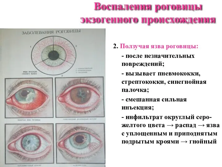 2. Ползучая язва роговицы: - после незначительных повреждений; - вызывает пневмококки,