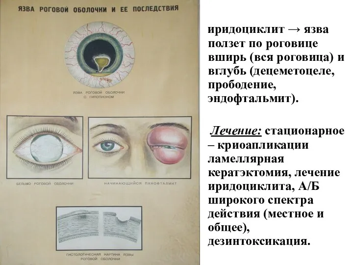 иридоциклит → язва ползет по роговице вширь (вся роговица) и вглубь