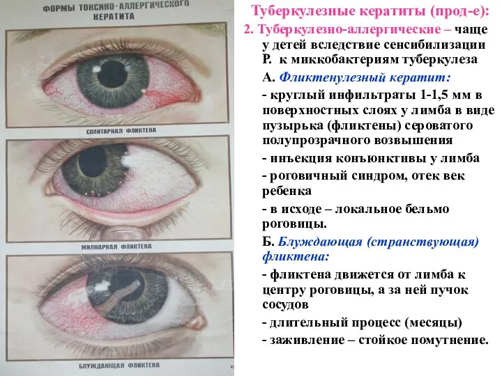 Туберкулезные кератиты (прод-е): 2. Туберкулезно-аллергические – чаще у детей вследствие сенсибилизации