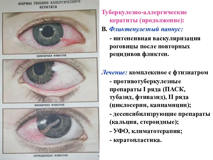 Туберкулезно-аллергические кератиты (продолжение): В. Фликтенулезный паннус: - интенсивная васкуляризация роговицы после