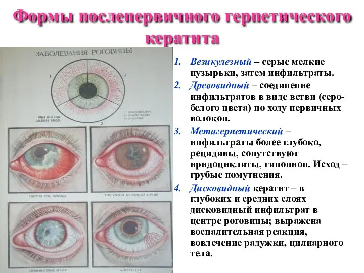 Формы послепервичного герпетического кератита Везикулезный – серые мелкие пузырьки, затем инфильтраты.