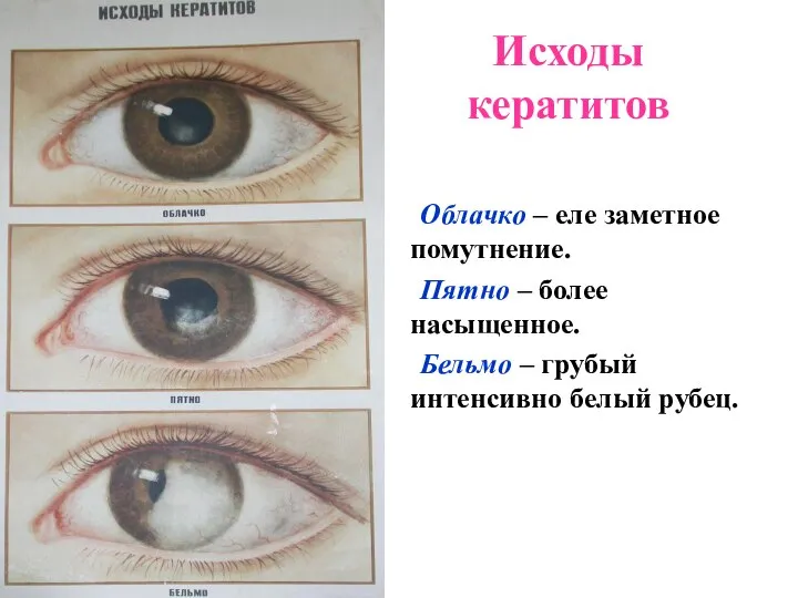 Исходы кератитов Облачко – еле заметное помутнение. Пятно – более насыщенное.