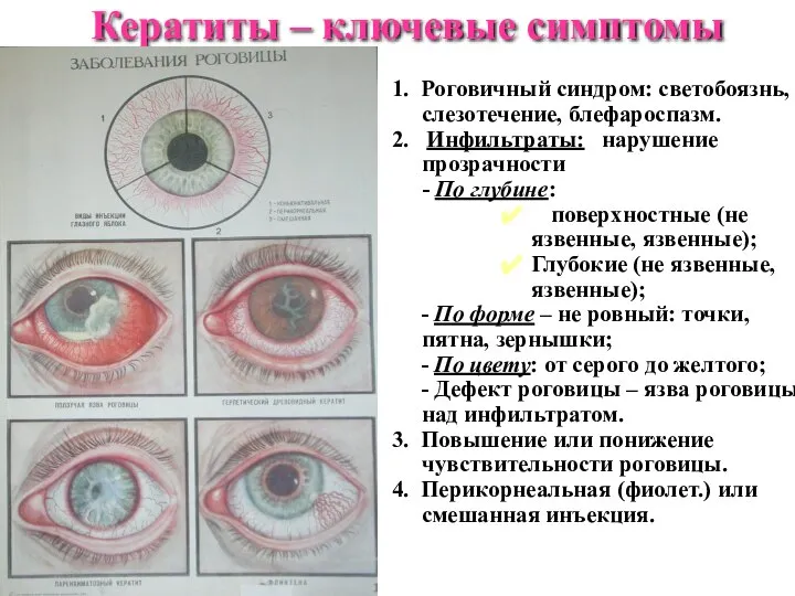 Кератиты – ключевые симптомы 1. Роговичный синдром: светобоязнь, слезотечение, блефароспазм. 2.