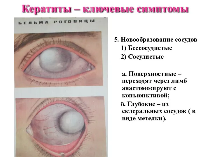 5. Новообразование сосудов 1) Бессосудистые 2) Сосудистые а. Поверхностные – переходят