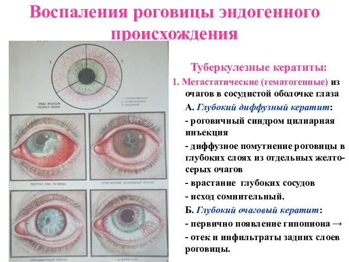 Воспаления роговицы эндогенного происхождения Туберкулезные кератиты: 1. Метастатические (гематогенные) из очагов