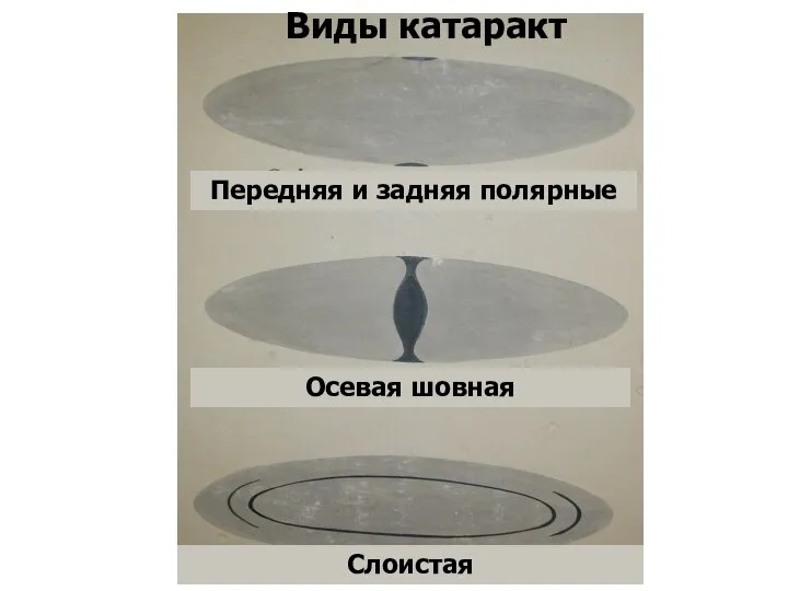 Передняя и задняя полярные Виды катаракт Слоистая Осевая шовная