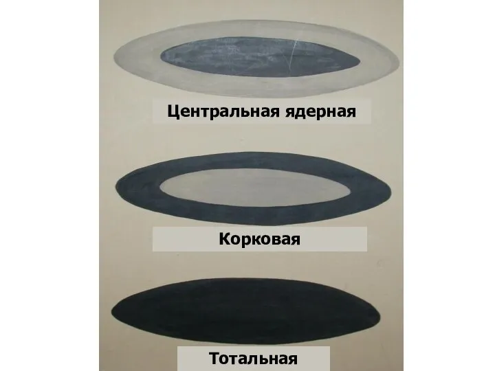 Центральная ядерная Корковая Тотальная