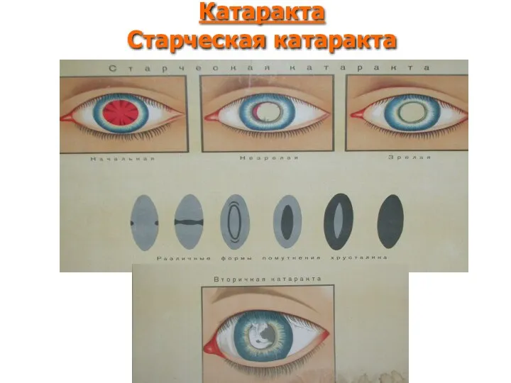 Катаракта Старческая катаракта