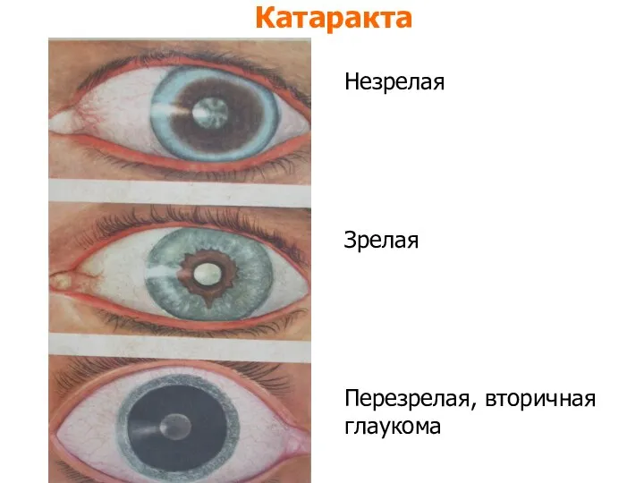 Катаракта Незрелая Зрелая Перезрелая, вторичная глаукома