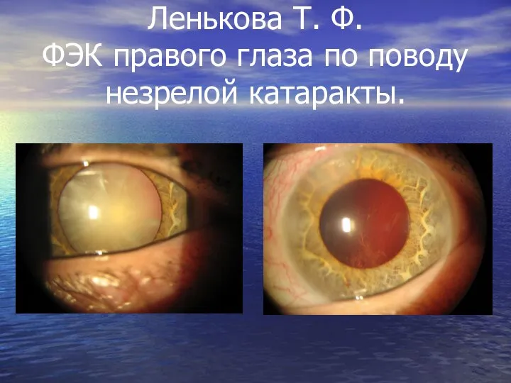 Ленькова Т. Ф. ФЭК правого глаза по поводу незрелой катаракты.