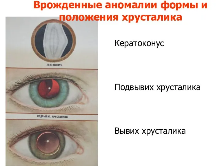 Врожденные аномалии формы и положения хрусталика Кератоконус Подвывих хрусталика Вывих хрусталика