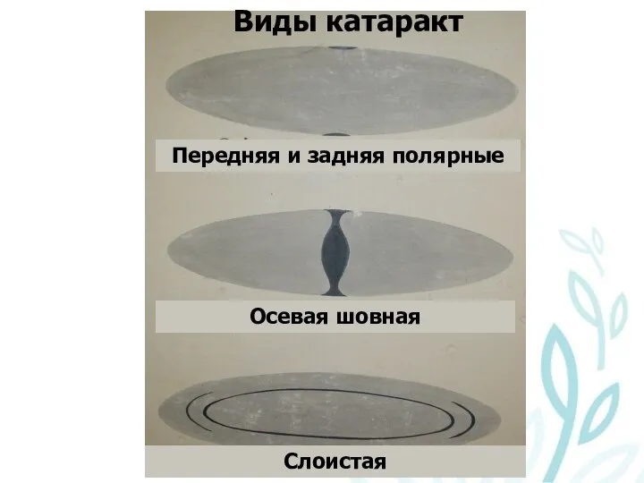 Передняя и задняя полярные Виды катаракт Слоистая Осевая шовная