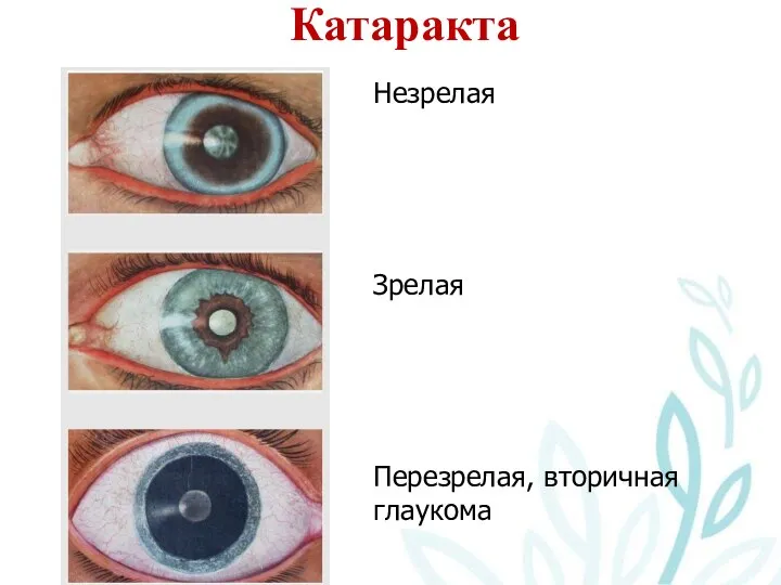 Катаракта Незрелая Зрелая Перезрелая, вторичная глаукома