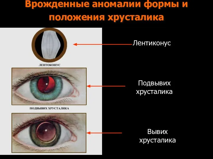 Врожденные аномалии формы и положения хрусталика Лентиконус Подвывих хрусталика Вывих хрусталика