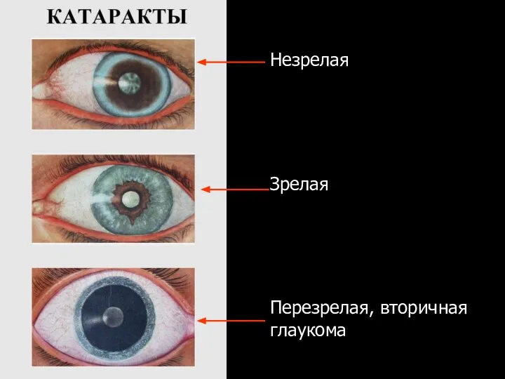 Незрелая Зрелая Перезрелая, вторичная глаукома