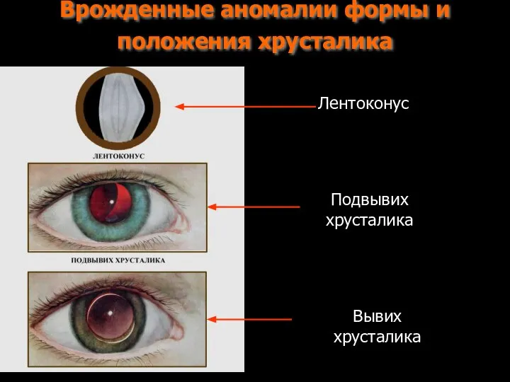 Врожденные аномалии формы и положения хрусталика Лентоконус Подвывих хрусталика Вывих хрусталика