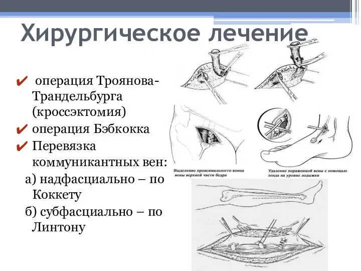 Хирургическое лечение операция Троянова-Трандельбурга (кроссэктомия) операция Бэбкокка Перевязка коммуникантных вен: а)