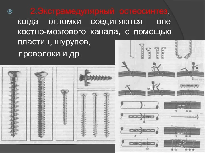 2.Экстрамедулярный остеосинтез, когда отломки соединяются вне костно-мозгового канала, с помощью пластин, шурупов, проволоки и др.