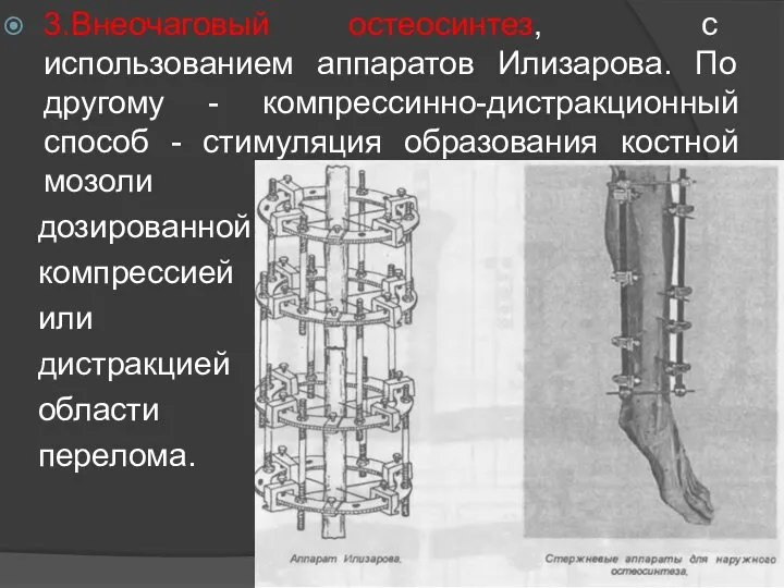 3.Внеочаговый остеосинтез, с использованием аппаратов Илизарова. По другому - компрессинно-дистракционный способ