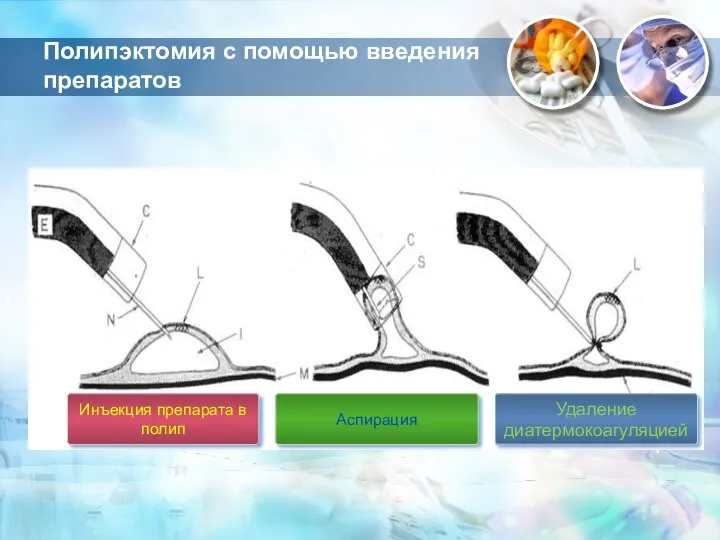 Полипэктомия с помощью введения препаратов Аспирация Инъекция препарата в полип Удаление диатермокоагуляцией