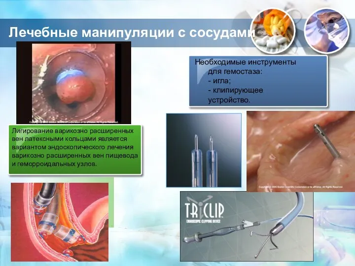 Необходимые инструменты для гемостаза: - игла; - клипирующее устройство. Лигирование варикозно