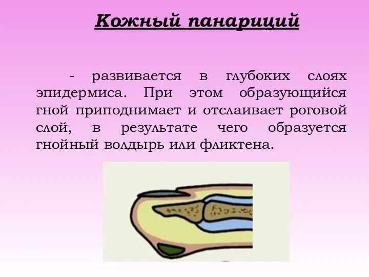 Кожный панариций - развивается в глубоких слоях эпидермиса. При этом образующийся