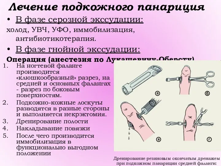 Дренирование резиновым окончатым дренажем при подкожном панариции средней фаланги: Лечение подкожного