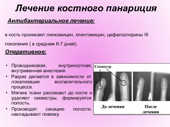 Лечение костного панариция Антибактериальное лечение: в кость проникают линкомицин, клинтомицин, цефалоспорины