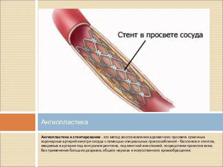 Ангиопластика и стентирование - это метод восстановления адекватного просвета суженных коронарных