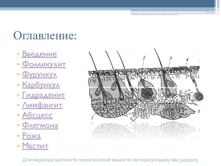 Оглавление: Введение Фолликулит Фурункул Карбункул Гидраденит Лимфангит Абсцесс Флегмона Рожа Мастит