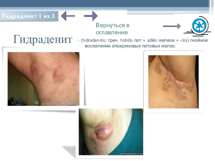 Гидраденит - (hidradenitis; греч. hidrōs пот + adēn железа + -itis)