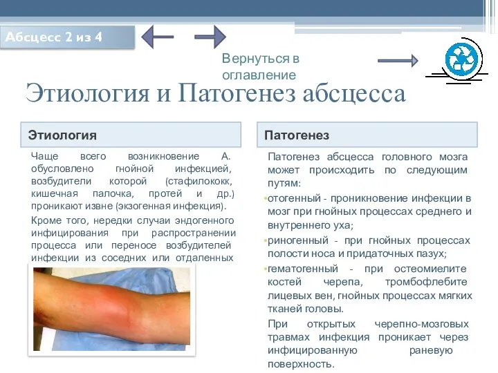 Этиология и Патогенез абсцесса Этиология Патогенез Чаще всего возникновение А. обусловлено