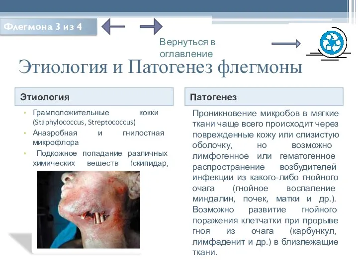 Этиология и Патогенез флегмоны Этиология Патогенез Грамположительные кокки (Staphylococcus, Streptococcus) Анаэробная