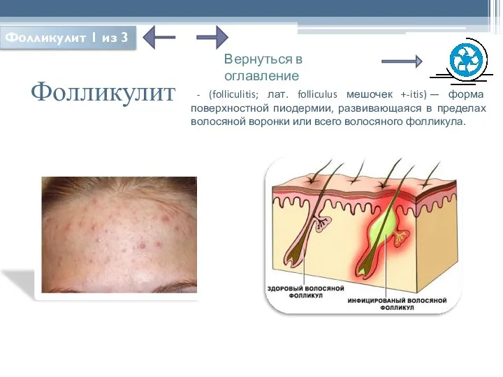 Фолликулит - (folliculitis; лат. folliculus мешочек +-itis) — форма поверхностной пиодермии,