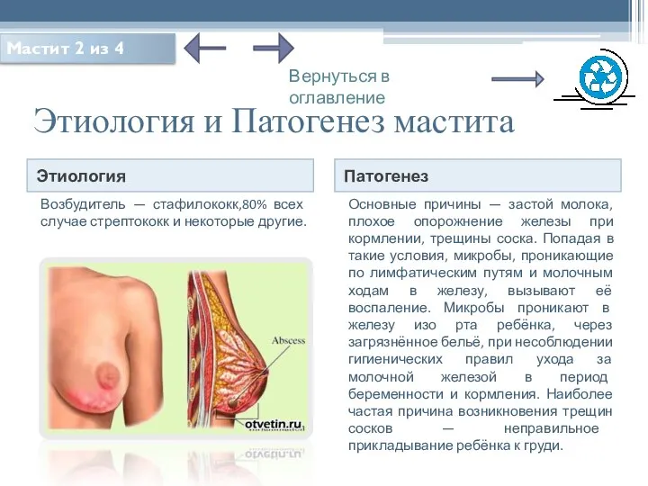 Этиология и Патогенез мастита Этиология Патогенез Возбудитель — стафилококк,80% всех случае