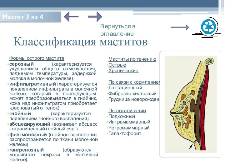 Классификация маститов Формы острого мастита серозный (характеризуется ухудшением общего самочувствия, подъемом