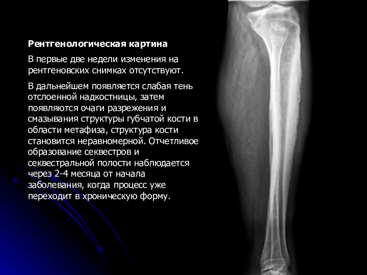 Рентгенологическая картина В первые две недели изменения на рентгеновских снимках отсутствуют.