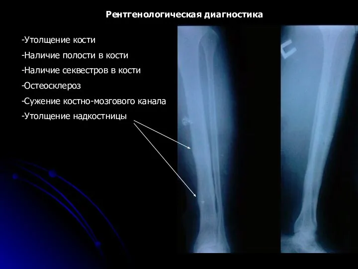 Рентгенологическая диагностика Утолщение кости Наличие полости в кости Наличие секвестров в