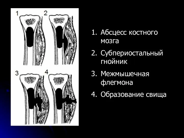 Абсцесс костного мозга Субпериостальный гнойник Межмышечная флегмона Образование свища