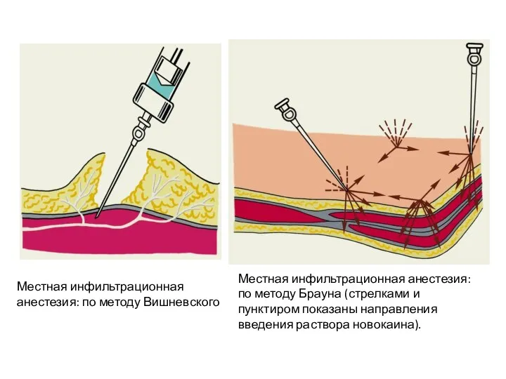 Местная инфильтрационная анестезия: по методу Брауна (стрелками и пунктиром показаны направления