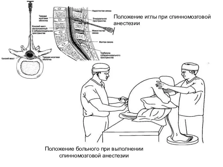 Положение иглы при спинномозговой анестезии Положение больного при выполнении спинномозговой анестезии
