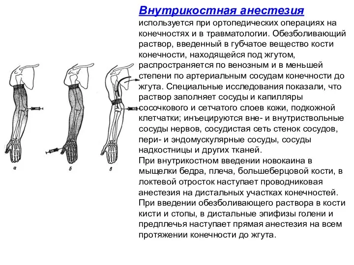 Внутрикостная анестезия используется при ортопедических операциях на конечностях и в травматологии.