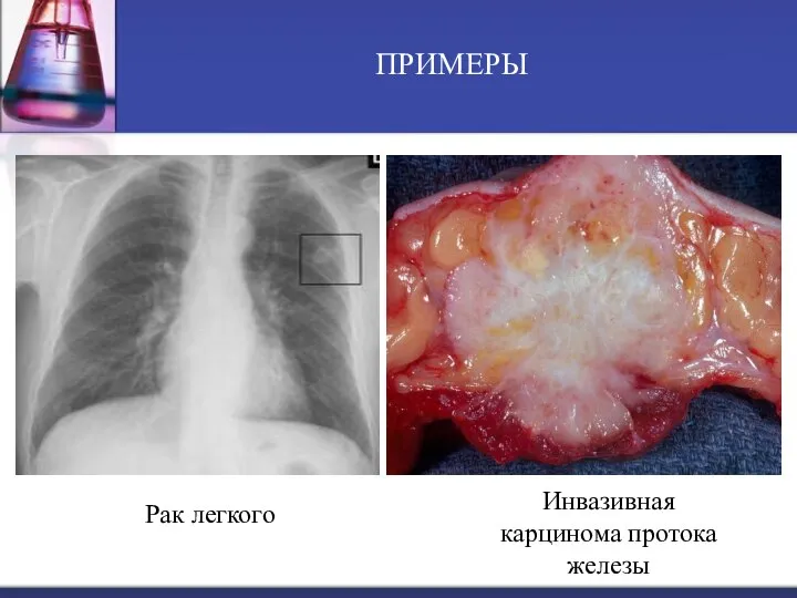 Рак легкого ПРИМЕРЫ Инвазивная карцинома протока железы