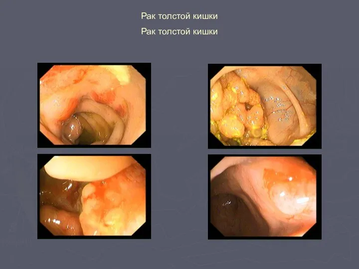Рак толстой кишки Рак толстой кишки
