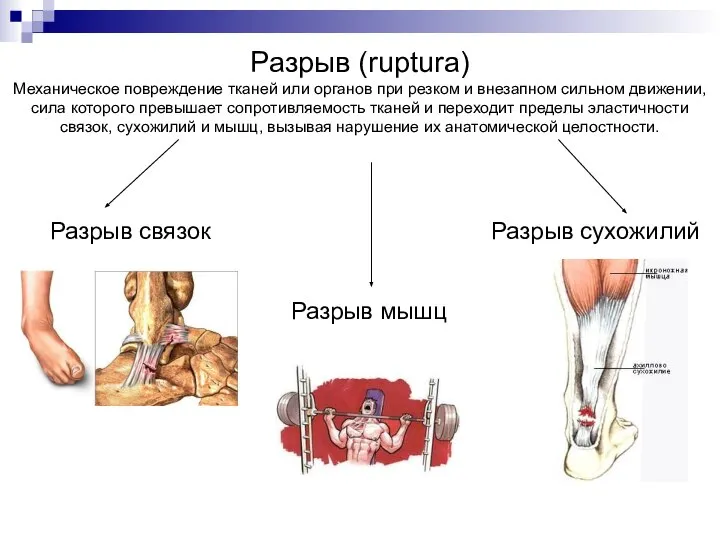 Разрыв (ruptura) Механическое повреждение тканей или органов при резком и внезапном