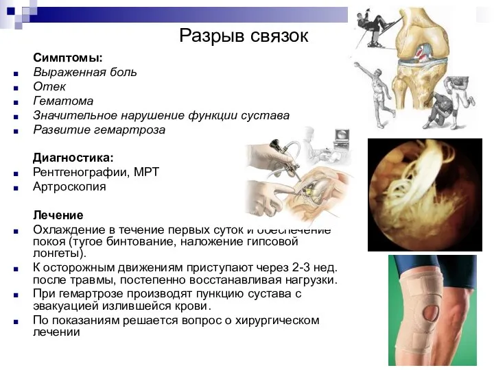 Разрыв связок Симптомы: Выраженная боль Отек Гематома Значительное нарушение функции сустава