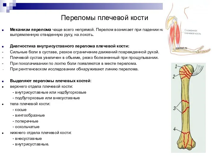 Переломы плечевой кости Механизм перелома чаще всего непрямой. Перелом возникает при