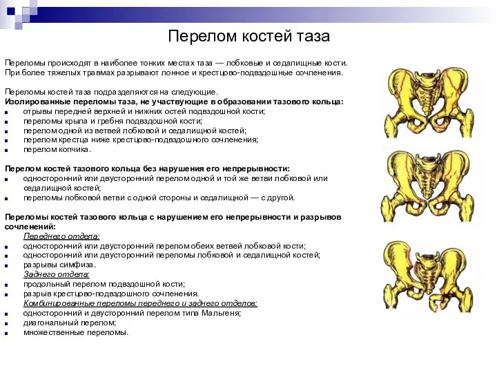 Перелом костей таза Переломы происходят в наиболее тонких местах таза —