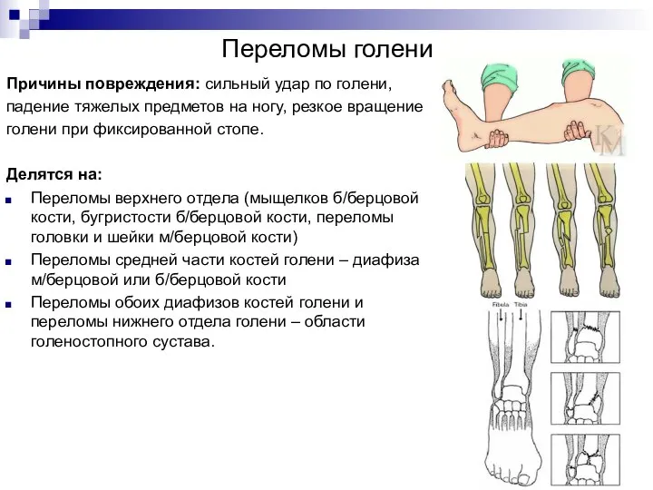 Переломы голени Причины повреждения: сильный удар по голени, падение тяжелых предметов